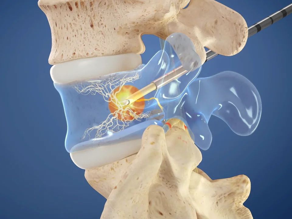 Chronic Low Back Pain &mdash; interventional pain care at Axis Pain Group