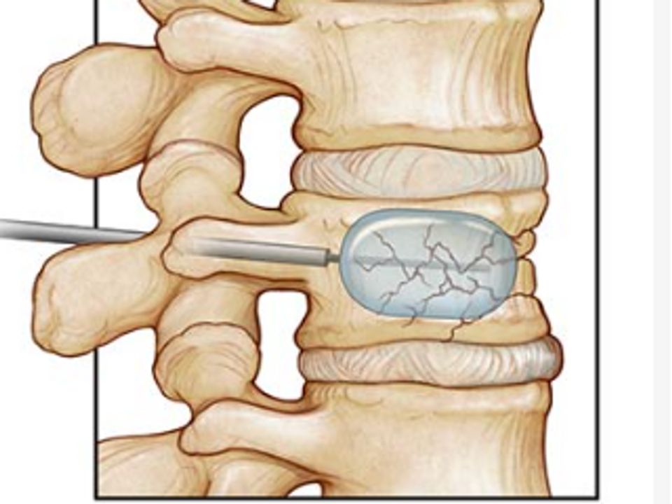 Chronic Refractory Pain &mdash; interventional pain care at Axis Pain Group